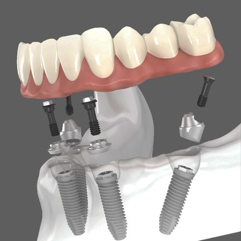 With the All-on-4 dental implant restoration method, patients have four to six dental implants placed in carefully planned locations in their mouth. Beautiful custom-designed dentures are secured to the implants, providing unparalleled stability to restore the patient’s teeth. 

Contact ☎️ (858) 481-5210
#SolanaSmiles #DentalImplants #AllOn4 Dental Implant Procedure, Implant Dentist, Dental Implants Cost, Missing Teeth, Sunny Isles, Family Dental, Natural Teeth, Dentures, Cosmetic Dentistry