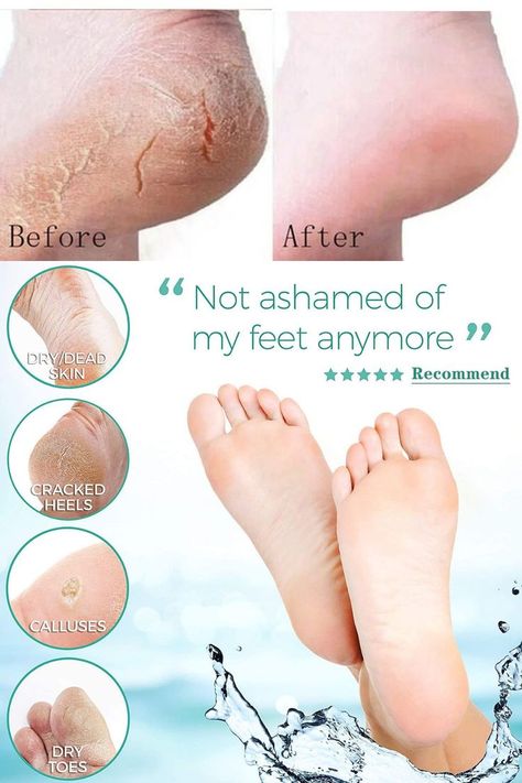 Anti Crack Foot Cream Feet Peel Mask Heel Cracked Dry Repair Cream Hand Peeling Removal Callus Dead Skin Hands Feet Car Cracked Heel Remedies, Skin Hand, Aesthetic Amazon, Cracked Heels, Foot Cream, Repair Cream, Repair, Mask, Cream