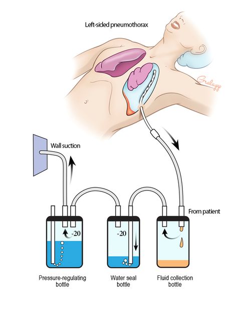 Chest Tubes Nursing Cheat Sheet, Chest Tube, Nursing School Motivation, Basic Anatomy And Physiology, Nurse Study Notes, Nursing Student Tips, Medical Student Study, Pulmonology, Nursing School Survival