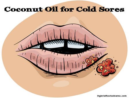 Coconut Oil for Cold Sores: HybridRastaMama.com Cold Sore Lip, Stuffy Nose Remedy, Get Rid Of Cold, Essential Oils For Colds, Canker Sore, Cold Sores, Cold Sores Remedies, Stuffy Nose, Cold Cough