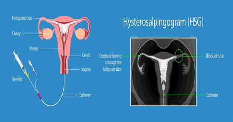 Discover how the HSG test can revolutionize your fertility journey, providing invaluable insights and enhancing your chances of conception. - #Advantages #benefits #gains #merits #perks #pluses #positiveaspects #Privileges #pros #strengths Hsg Test, Blocked Fallopian Tubes, Improve Fertility, Fallopian Tubes, In Vitro Fertilization, Reproductive System, Reproductive Health, Fertility, Benefits