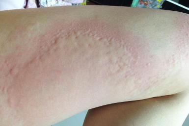 Hives and Heat Rash: Cholinergic urticaria is caused by excessive heat exposure. How To Treat Hives, Rashes Remedies, Varicose Vein Removal, Heat Rash, Allergy Remedies, Vitamin Deficiency, Sinus Infection, Vitamins For Skin, Allergic Reaction