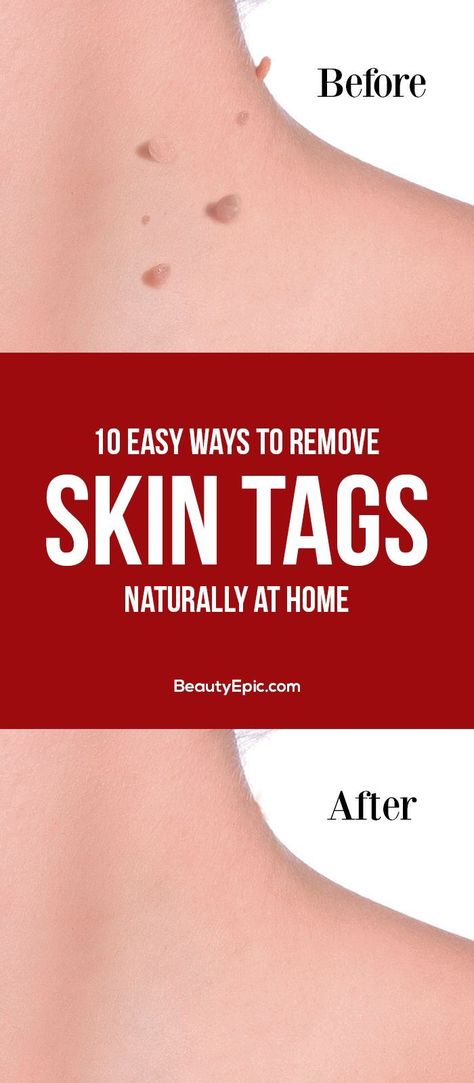 Remove Skin Tags, Warts On Face, How To Remove Warts, Remove Skin Tags Naturally, Remove Warts, Home Remedies For Skin, Get Rid Of Warts, Skin Natural Remedies, Skin Tags