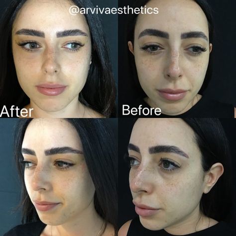 Fox Eyes Aesthetic, Fox Eye Surgery, Hooded Eye Surgery, Fox Eye Lift, Eye Lift Surgery, Almond Eye Makeup, Foxy Eyes, Types Of Facials, Eyes Aesthetic