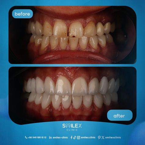 😊Imagine the Possibilities! Envision a smile that radiates beauty and confidence with SmileX's new crowns.  👀Witness the breathtaking difference in our before and after pictures.  😜Dare to dream of a perfect smile—  📞reach out to us for an appointment!  ⚪ISTANBUL TÜRKÌYE  https://wa.me/905491081512⁠ ⁠ #orthodontics #straightteeth #veneers⁠ #tooth #dentalimplants #teethwhitening ⁠ #dentist #dental #dentistry #teeth⁠ #İstanbul #türkiye Dental Veneers Before And After, Dental Before And After, Straight Teeth, Dental Veneers, Dare To Dream, After Pictures, Perfect Smile, Before And After Pictures, Dental Implants