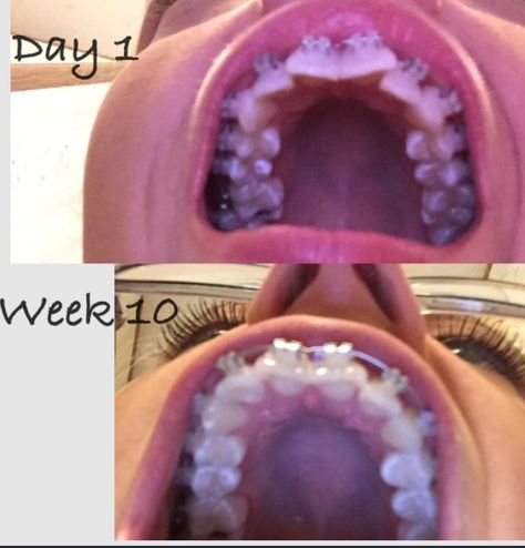 Only 10 weeks later #braces #clearbraces #adultbraces #teeth #smile #transformation Braces Transformation, Adult Braces, Clear Braces, Braces Tips, Smile Teeth, Braces, Acai Bowl, Bowl, 10 Things