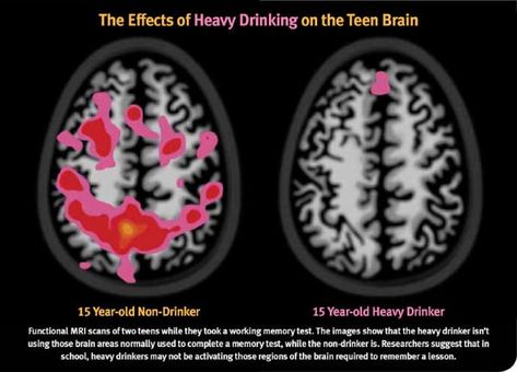 Risky Behavior, Teenage Brain, Memory Test, Heavy Drinking, Effects Of Alcohol, Frontal Lobe, Colleges In Florida, White Matter, Mri Scan