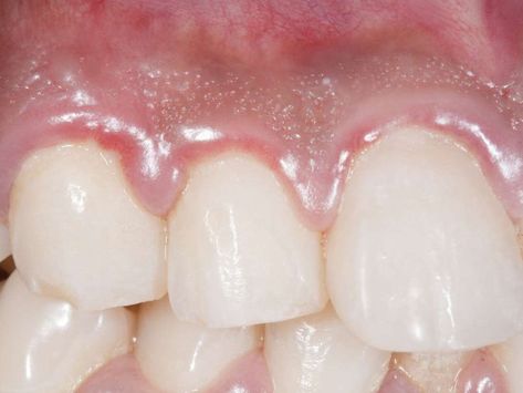 What to do about swollen gums Swollen Gums Remedy, Gum Surgery, Gum Inflammation, Swollen Gum, Gum Recession, The Teeth, Periodontal Disease, Receding Gums, Oral Hygiene