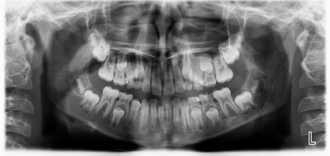 Panoramic taken on our office on a 10 year old child, showing permanents as well as primary teeth unerupted. Kidney Tumor, Extra Teeth, Xray Art, Cat Scan, Pregnant Cat, Rare Disorders, Tooth Pain, The Teeth, Natural Background