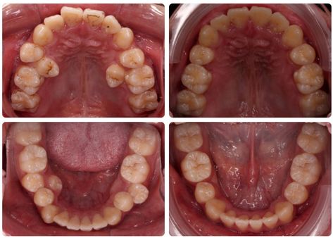 Invisalign before and after Cosmetic Bonding, After Braces, Orthodontic Office, Front Teeth, After Pictures, Before And After Pictures, Real Results, Take Care Of Me, Use Case