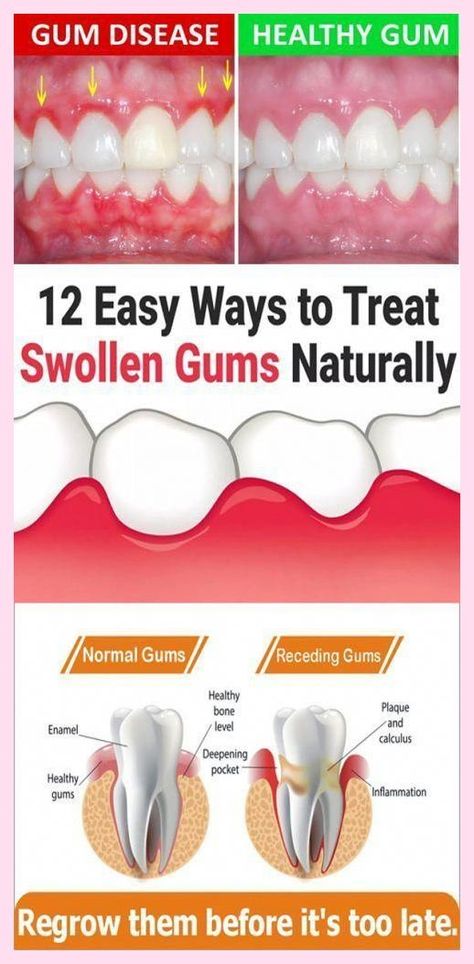 I appreciate your kind posts. Inestimable  tips Swollen Gum, Dental Cavities, How To Prevent Cavities, Medical Terminology, Periodontal Disease, Oral Care Routine, Receding Gums, Gum Care, Healthy Bones