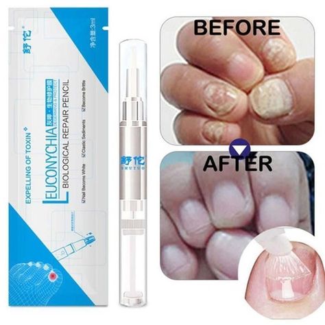 Learn how to repair nails damaged by acrylics. Damaged Nails Repair, Nails Repair, Nail Polish Design, Nail Infection, Polish Design, Fungal Nail, Nail Repair, Damaged Nails, Toenail Fungus