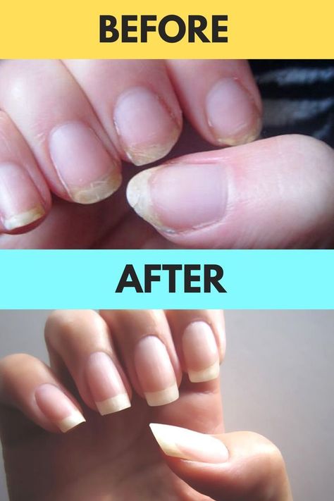 How To Get Long Nails Overnight At Home, How To Grow Strong Nails, How To Make Nails Grow Faster Overnight, How To Make Your Nails Grow Overnight, How To Grow Nails Faster In A Day, Nail Growth Tips Faster Overnight, How To Get Long Nails Overnight, How To Make Your Nails Grow Faster, How To Grow Nails Faster Overnight