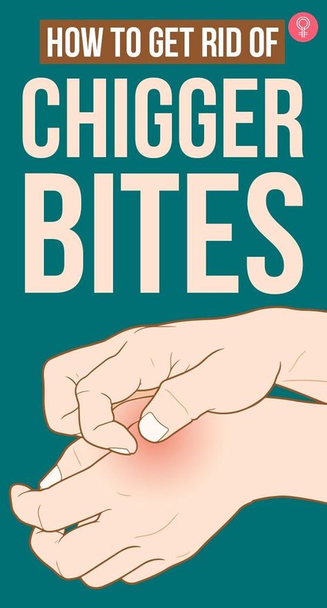 Chigger Bite Remedy, Bite Relief, Kitchen Ingredients, Natural Headache Remedies, Natural Sleep Remedies, Bug Bites, Body Pain, Homemade Remedies, Healthy Lifestyle Tips