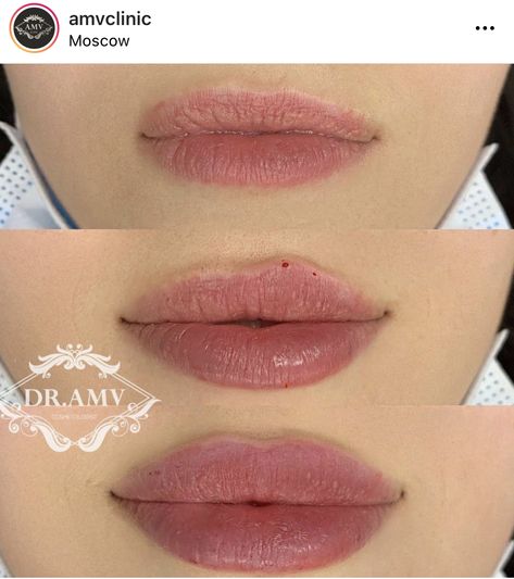 Dermal Fillers Lips, Lips Inspiration, Lip Types, Evening Eye Makeup, Botox Lips, Facial Fillers, Facial Contouring, Facial Aesthetics, Crazy Ideas