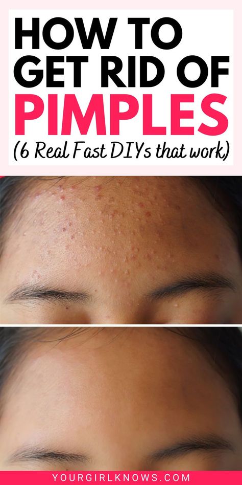 As much as we wish that acne didn't exist, sadly, they do. And when they do, almost all of us are searching for the best answers to how to get rid of acne fast? Rid Of Acne Overnight, Get Rid Of Acne Overnight, Get Rid Of Pimples, Rid Of Pimples, Forehead Acne, Acne Overnight, Pimples Overnight, Pimples Remedies, Diy Acne