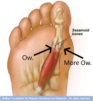 The pain I live with... Sesamoid bones!     Its why I started doing bikram yoga..  check out my blog about the removal of my sesamoid   www.vanitysanityandhealth.com Sesamoid Bone, Hand Spa, Exercise Moves, Karate Kata, Remedial Massage, Nursing Information, Dancer Problems, Energy Therapy, Start Blogging