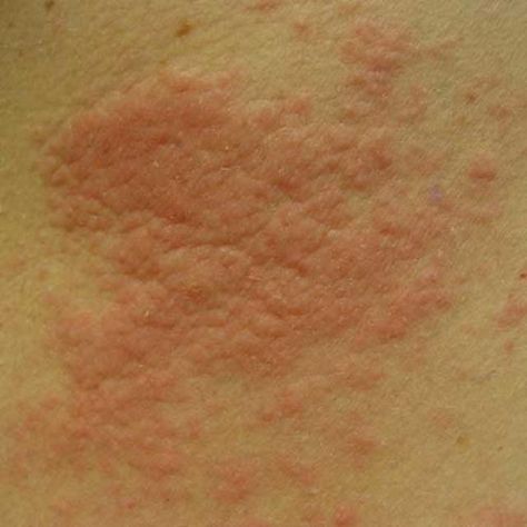 Hives, also know as urticaria, are a common cause of itchy rashes.  Find out what hives looks like in these hives pictures. Rash On Stomach, Skin Rash Remedies, Skin Rashes Pictures, Allergic Reaction Rash, Hives Rash, Types Of Skin Rashes, Common Skin Rashes, Fungal Rash, Rash On Face