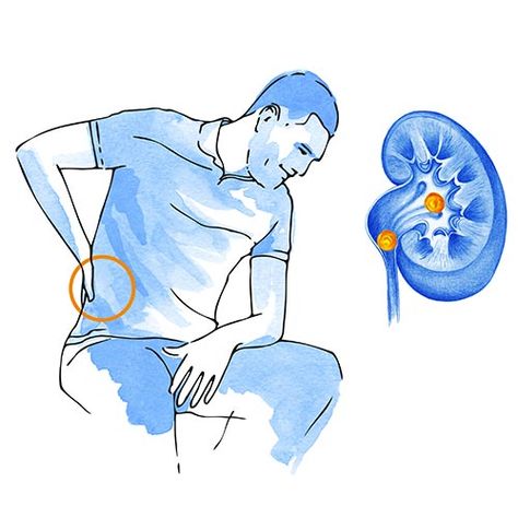 ℹ️🏥 La #litiasis es una enfermedad renal crónica, caracterizada por la formación de cálculos renales (piedras) en el riñón o la vejiga. La prevalencia de la litiasis en España es de aproximadamente el 12% de la población, afectando mayoritariamente a adultos jóvenes entre 15 y 45 años, siendo poco frecuente en adultos de más de 65 años y más frecuente en hombres que en mujeres. Marbella, Health, Quick Saves