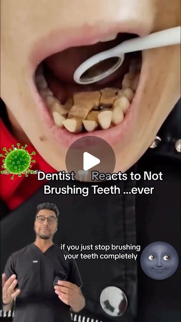 Dentistry on Instagram: "Post by • @dentite313 This a rare case of never brushing your teeth 🦷 why this occurs, bacteria 🦠 will overtake the mouth . And it will “derode “ the teeth , bone and gums. Meant to say deteriorate but derode stuck in my head 🤣" Eye Surgery Humor, Teeth Cleaning Videos, Tartar Removal From Teeth, Teeth Tartar Removal, Complete Denture, Abscess Tooth, Affordable Dentures, Teeth Surgery, Rotten Teeth