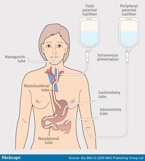 www.smileeachandeveryday.com Guide to tube feeding: TPN, NG, NJ, PEG, PEJ Gastrointestinal Nursing, Parenteral Nutrition, Medical Terminology Study, Nurse Skills, Pediatric Nurse Practitioner, Nurse Study Notes, Nursing School Survival, Search Google, Nursing School Studying