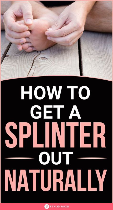 Getting Splinters Out, Sliver Removal, Draw Out Splinter, Splinter Removal, Wood Shavings, Summer Health, Cold Medicine, Cold Remedies, Natural Care