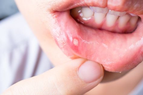 Mouth sores are one of the most common minor health issues. The medical world sometimes refers to them as canker sores. They often appear on the gums, but they also develop on the tongue and the inner part of the lower lip. There are many easy-to-find and inexpensive natural remedies for mouth sores are effective. Canker Sore Causes, Ulcer Remedies Mouth, Canker Sore Remedy, Canker Sore, Vitamin Deficiency, Sikat Gigi, Lower Lip, Cold Sore, Jairzinho