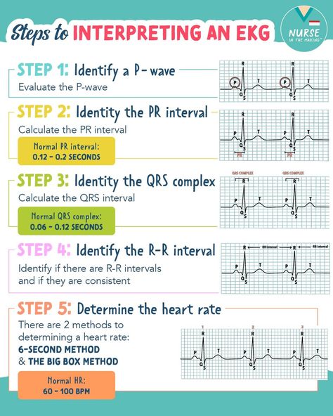 12 Lead Ekg Interpretation Made Easy, Ekg Interpretation Made Easy, Ekg Leads, Ekg Tech, Ekg Rhythms, Nursing School Studying Cheat Sheets, Pharmacology Studying, Ekg Interpretation, Ecg Interpretation