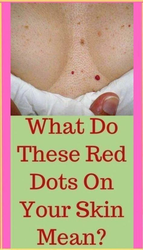 What do these red dots on your skin mean? Red Dots On Skin, Red Spots On Skin, Red Skin Spots, Health For Women, Spots On Skin, Healthy Woman, What Is Health, Healthy Living Inspiration, Health Women