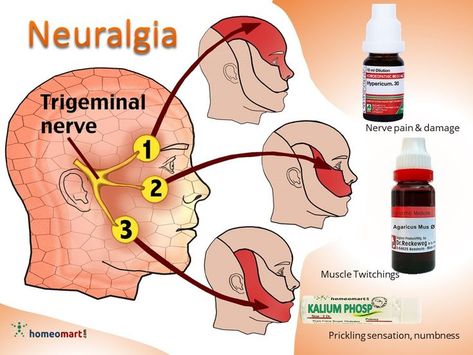 Neuralgia or Nerve pain across face diagram with medicines Homeopathic Medicine Cabinet, Nerve Pain Remedies, Teeth Remedies, Homeopathy Remedies, Muscle Twitching, Nerve Health, Homeopathy Medicine, Ayurvedic Remedies, Muscle Weakness