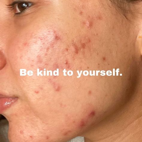 Note to self ❤️⁠ Face Mapping Acne, Blind Pimple, Forehead Acne, How To Get Rid Of Pimples, Skin Condition, Clearer Skin, Love Your Skin, Pretty Skin, Acne Remedies