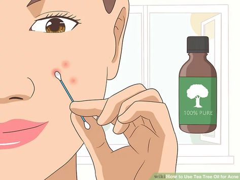 How to Use Tea Tree Oil for Acne: 12 Steps (with Pictures) Tee Tree Oil, Tea Tree Oil Uses, Oils For Dandruff, Cystic Acne Remedies, Tea Tree Oil For Acne, Skin Tea, Bad Acne, Natural Acne Remedies, Acne Oil