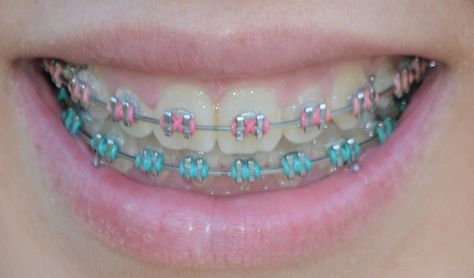 Braces Retainer, Cute Braces Colors, Braces Tips, Getting Braces, Cute Braces, Brace Face, Braces Colors, Dental Braces, Teeth Braces