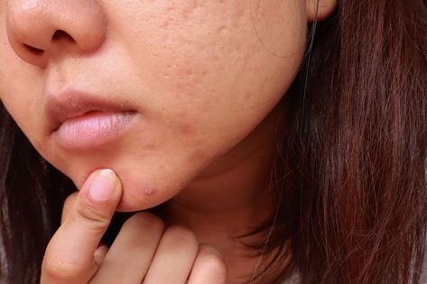 Tretinoin Before And After, How To Treat Blackheads, What Are Blackheads, Treating Cystic Acne, Sebaceous Filaments, Post Inflammatory Hyperpigmentation, Cosmetic Dermatology, Acne Scar, Types Of Acne