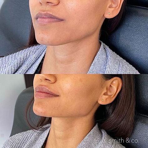 chin + jawline here we injected JUVÉDERM® VOLUMA XC to enhance her profile by bringing out her chin projection. We also built out the the angle of the jaw. By doing so not only did we balance her profile we also extended her jawline making it look slimmer and longer giving her a more contoured look. The chin is one of the most important elements to a good jawline. When people ask what will make the biggest impact to improving their jawline kybella, threads, ect. Cheek Contouring, Facial Balancing, Good Jawline, Juvederm Voluma, Danielle Smith, Botox Before And After, Botox Filler, Cheek Contour, Cheek Fillers