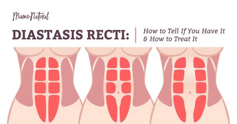 Diastasis Recti: Do You Have It? Plus How to Treat It Pregnancy Abs, Mama Natural, Diastasis Recti, After Pregnancy, Fitness Blog, Home Remedies, Health Tips, Beauty