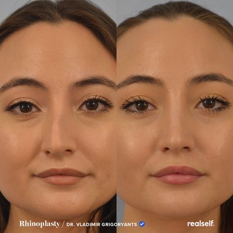 Crooked Nose Front View, Nose Job Front Profile, Straight Nose Front View, Crooked Nose Contouring, Nose Job Inspo Front View, Rhinoplasty Front View, Subtle Nose Job, Nose Job Front View, Rhinoplasty Recovery Timeline