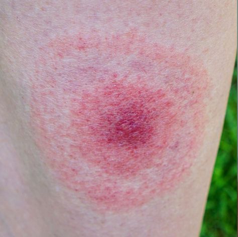 From ticks to spiders to bed bugs, they’re all pretty gnarly. Brown Recluse Spider Bite Pictures, Spider Bites Remedies, Tick Bites On Humans, Brown Recluse Spider Bite Stages, Deer Tick Bite, Bed Bug Bites Pictures, Achilles Bursitis, Spider Bites Pictures, Recluse Spider Bite