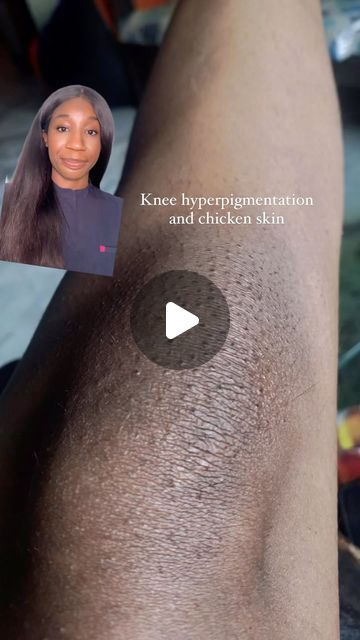 Dark Knees Remedy Fast, Glycolic Acid Before And After, Body Retinol, Ashy Knees, Glowing Body Skin, Dark Knees, Smooth Glowing Skin, Exfoliating Body Wash, Mini Facial