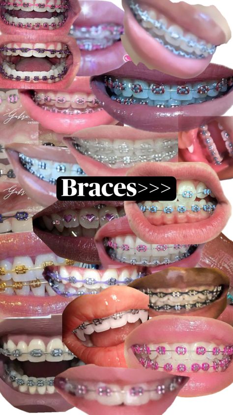 Braces Perfect Teeth Braces, Power Chain Braces, Braces Colors Combinations, Cute Braces Colors, Pretty Teeth, Braces Tips, Getting Braces, Cute Braces, Brace Face