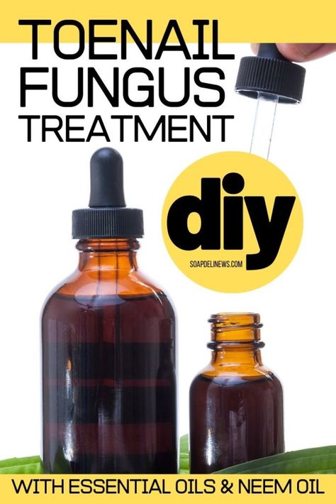 Diy Antifungal Cream, Toenail Fungus Essential Oils, Nail Remedies, Antifungal Cream, Toenail Fungus Remedies, Nail Fungus Remedy, Natural Recipes, Vapor Rub, Foot Scrub