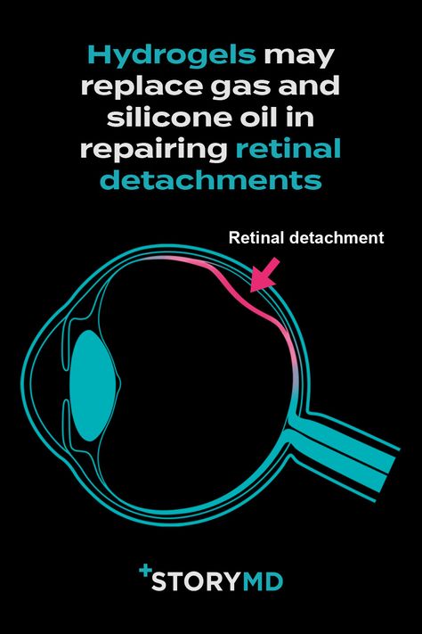 Cross section of the eye showing retinal detachment Staring At The Ceiling, The Ceiling, No More, Surgery, The Future, Conditioner, Medical, Repair, Ceiling