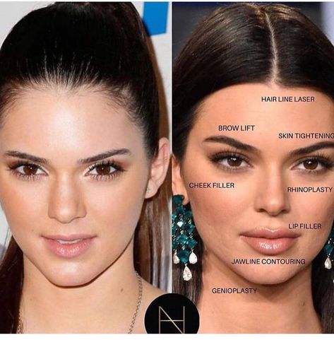 Kendall Jenner Plastic Surgery, Face Plastic Surgery, Cosmetic Fillers, Face Fillers, Face Surgery, Cheek Fillers, Facial Fillers, Cosmetic Dermatology, Celebrity Plastic Surgery