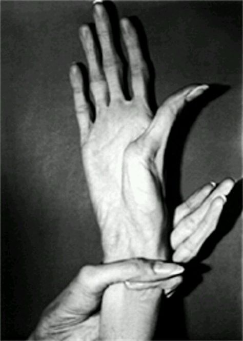 Hand deformity caused by Marfan syndrome Human Oddities, Genetic Disorders, Ehlers Danlos Syndrome, Unusual Things, Medical History, Miyazaki, Medical Conditions, Human Body, Medical