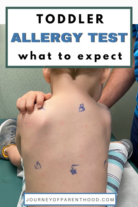 What you need to know when your toddler has an allergy test. Allergy testing can be stressful for both parent and child so here are some tips to make the appointment as smooth as possible for everyone! #toddlerallergytesting #allergytesting #allergytest Toddler Allergies, Toddler Meltdowns, Toddler Chores, Toddler Parenting, Baby Feeding Schedule, Tantrums Toddler, Toddler Discipline, Allergy Testing, Toddler Development