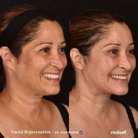 Face Fat Before And After, Fat Transfer To Face, Voluma Cheeks Before And After, Forehead Reduction Before And After, Face Fat Loss Before And After, Facial Fat Loss, Face Procedures, Facial Reconstruction Historical, Fat Transfer