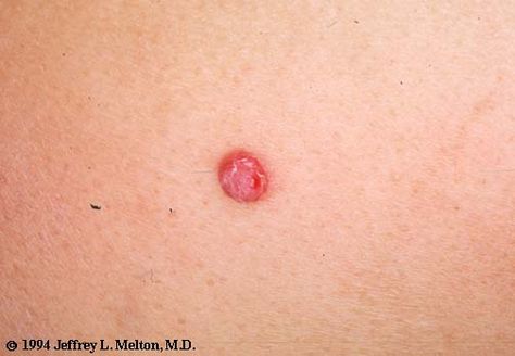 Pyogenic granuloma (2) Human Oddities, Button Piercing, Belly Button Piercing, Dermatology, Belly Button, Immune System, Belly Button Rings, Surgery, Florence