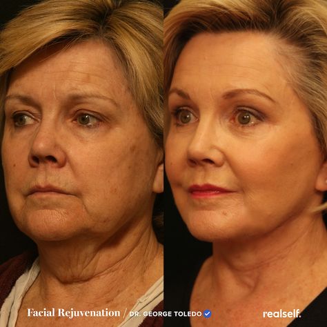 Face Lift Before And After, Sagging Skin Face, Facelift Recovery, Sagging Skin Remedies, Facelift Without Surgery, Facelift Before And After, Facial Procedure, Facial Routine Skincare, Face Fillers