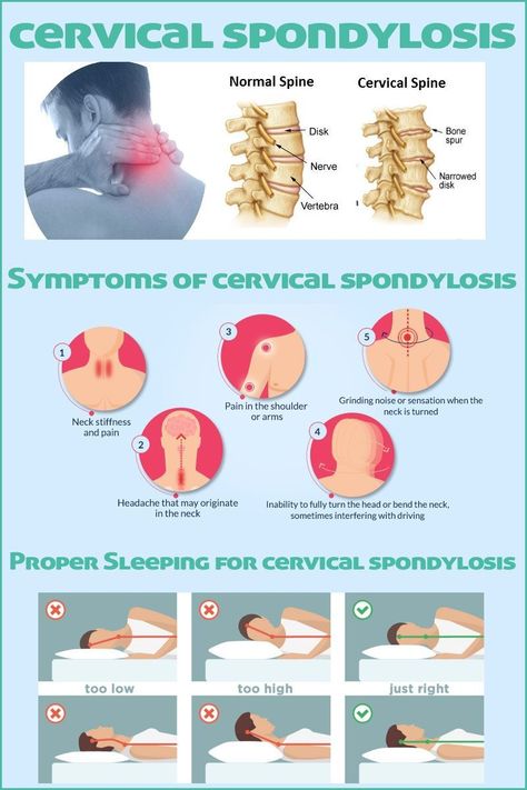 Cervical Spondylosis Exercises, Cervical Spine Exercises, Cervical Pain Exercises, Cervical Pain, Cervical Spondylosis, Neck Exercises, Spine Health, Cervical Spine, Neck And Shoulder Pain