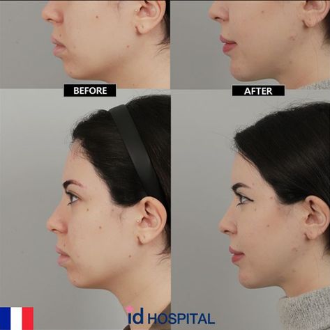 Concerned about your short and receding chin? 🙀 . V-Line surgery is recommended to augment the chin using your own bone. 😼 #plasticsurgery #chinsurgery #koreanplasticsurgery #beforeafter #beauty #vline #vlinesurgery #gangnam #koreanbeauty V Line Surgery Before And After, Receding Jawline, Receding Chin, Chin Surgery, Face Plastic Surgery, V Line Surgery, V Line Face, Korean Plastic Surgery, Nose Jobs